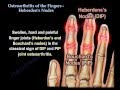 Osteoarthritis Of The Fingers, Heberden's Nodes - Everything You Need To Know - Dr. Nabil Ebraheim