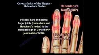 Ce sunt nodulii Heberden?