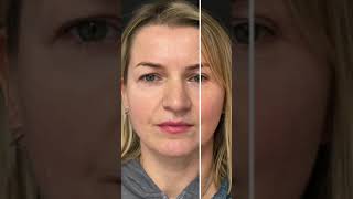 Before and After Upper Blepharoplasty (Eyelid Surgery)