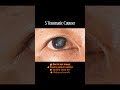Types of Cataract | Motiyabind in eye | #shorts #explore #optometry #eyecare #mbbs #ophthalmology