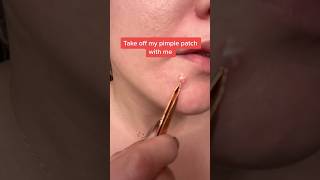 Take off SLMD Salicylic Acid Pimple Patches🩹💥 #drpimplepopper #pimplepatch #slmdskincare