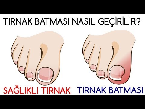 Tırnak Batması Nasıl Geçirilir