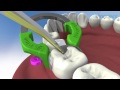 Class II composite restoration using V3 Sectional Matrix System - Triodent