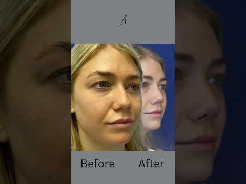 Video thumbnail: I like my New Nose! | Septorhinoplasty by Dr. Ali Sajjadian · Ali Sajjadian