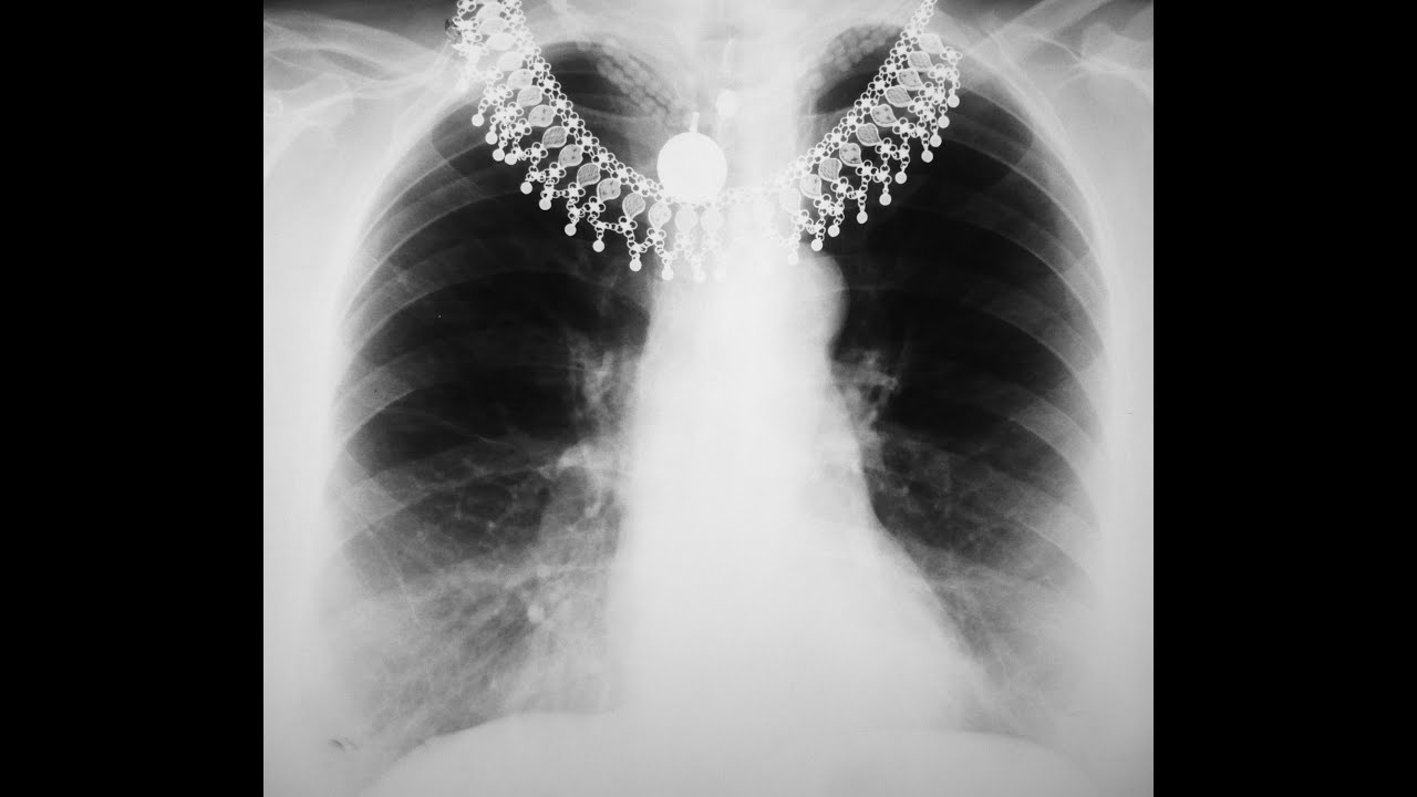 Learn How to Read a Chest X-Ray