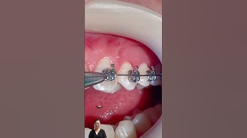 Cái nịt trong nha khoa! Trợ thủ đắc lực cho niềng răng #nieng #drhuong