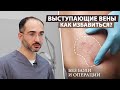 Лечение вен с помощью метода склеротерапия