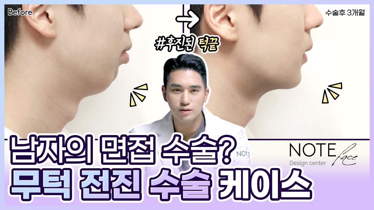 [유.케.리] 📍 CT로 보는 케이스 리뷰 l 턱 끝 전진술 l 무턱 수술 l - YouTube