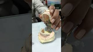 Dental smile # dentist # trending # viral shorts # daat ki मुश्कान # happy face# ceramic bridge