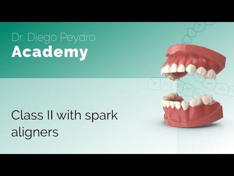 Class II with spark aligners
