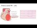 EKG 7.1