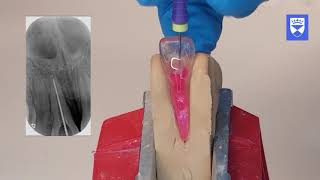 Endodontic treatment of the single rooted tooth. Part 3:  Glide path preparation