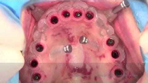 IMMEDIATE LOADING GUIDED SURGERY ATROPHIC MAXILLA dr.Giampiero Ciabattoni Digital Implantology Video