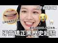 牙齒大補貼EP2: 戴兩次矯正器學到的慘痛經驗....各種牙套黑歷史大公開