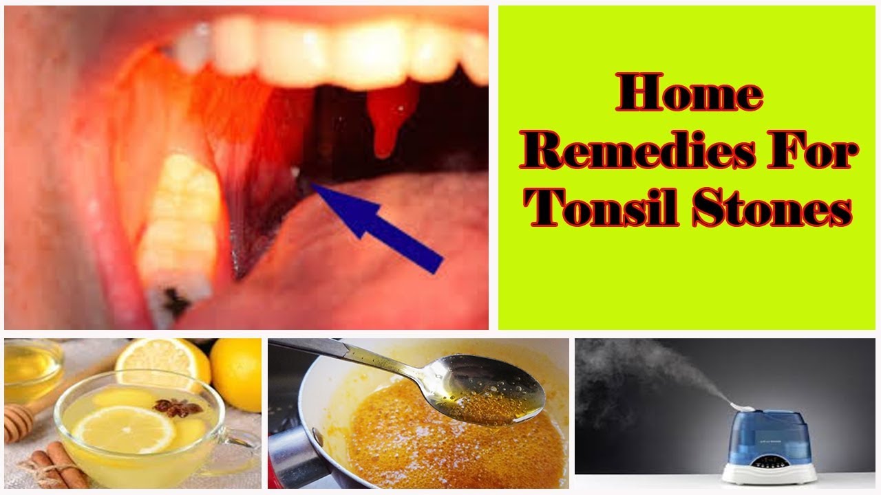 Home Remedies For Tonsil Stones Removal V 4 You Youtube