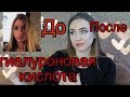 ГИАЛУРОНОВАЯ КИСЛОТА . ДО И ПОСЛЕ