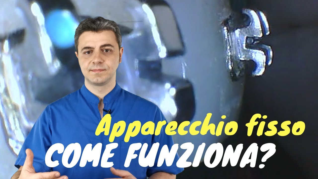 Come funziona l'apparecchio fisso (in dettaglio)
