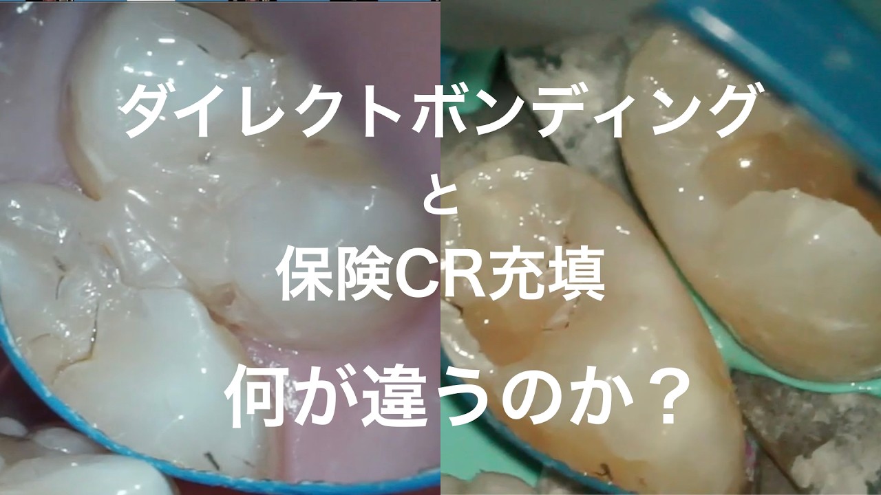 自費治療のダイレクトボンディングは保険のCR充填と何が違うのか？