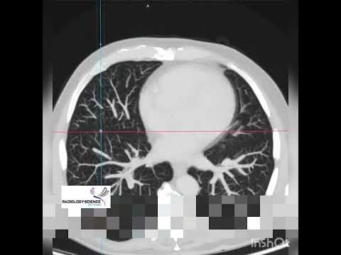 تفسیر سی تی اسکن ریه و آنژیوگرافی پولمونر