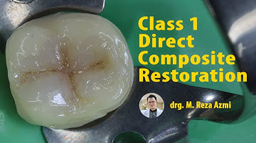 Class I Direct Composite Restoration | Operative Dentistry, Polofil NHT (Nano Hybrid Composite)