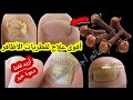 معجزة القرنفل سبحان الله يقضي على فطريات الأظافر والتسوس ستعود كما كانت وصفة تغنيك عن الطبيب 