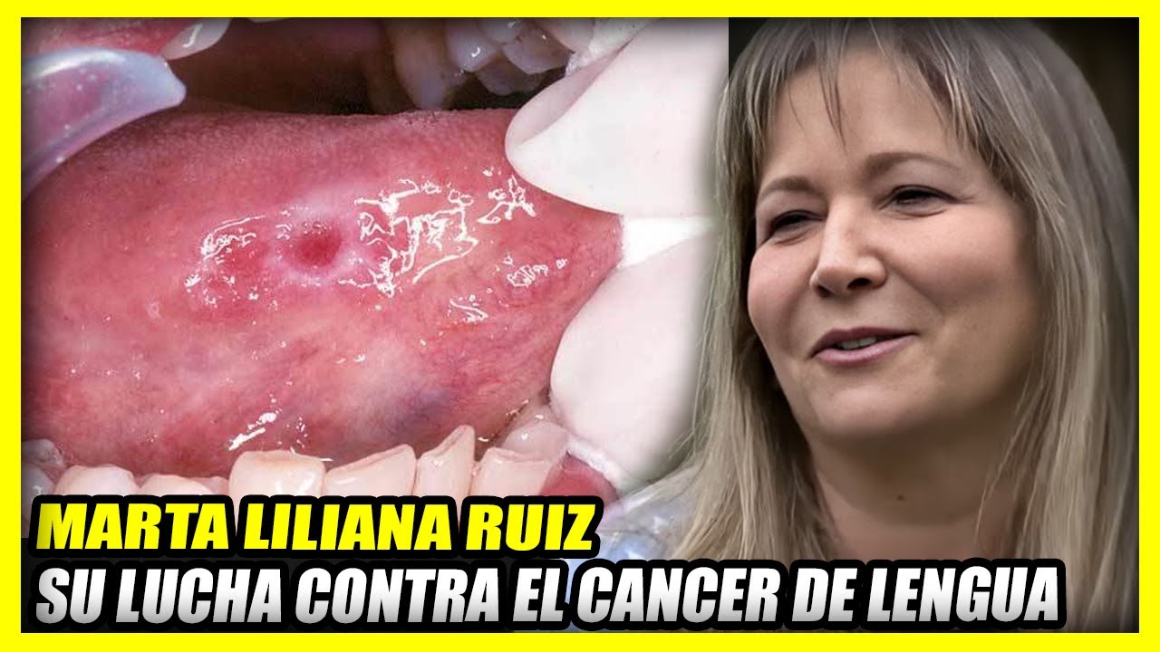 MARTA LILIANA RUIZ Y SU LUCHA CONTRA EL C NCER DE LENGUA YouTube