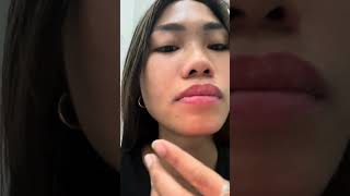 Tooth Extraction🦷