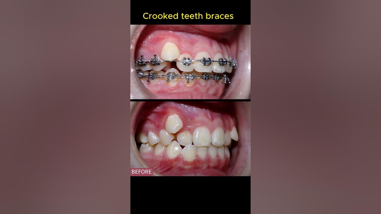 What Do You Call Crooked Teeth