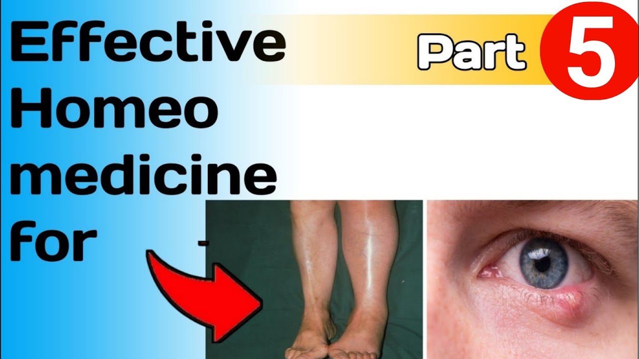 Homeopathy treatment of Stye Part 5 12 October 2021 YouTube