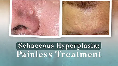 Sebaceous Hyperplasia: Painless Treatment