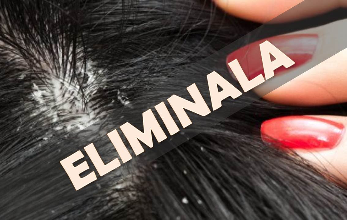 como-combatir-la-dermatitis-seborreica