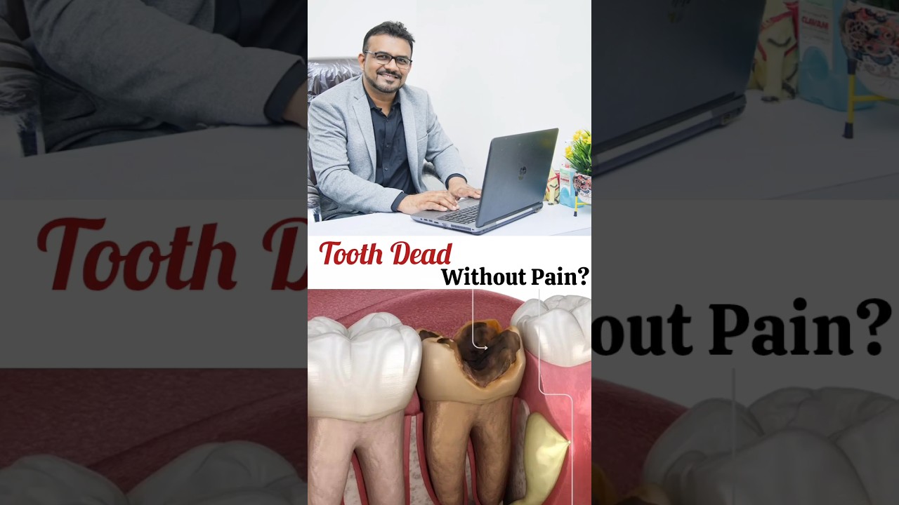Can a Tooth Die Without Pain – Painless Infection Explained!