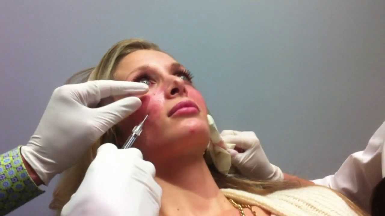 Blunt micro-cannula technique for under eye (tear trough) and cheek, Mrs of USA, Steve Weiner, MD