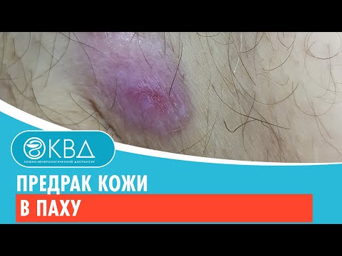 😧 Предрак кожи в паху. Клинический случай №548