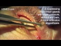 Occluded meibomian glands. Expressing under local anaesthesia. Dr. Aral - Cologne.