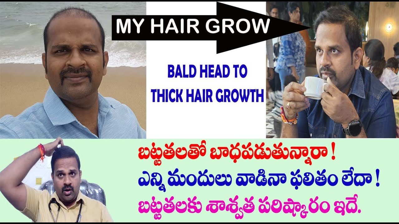 my hair growth from bald head to thick hair | bald head final destination | hair loss