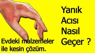 Yanık Acısı Nasıl Geçer ? (evdeki malzemeler ile )