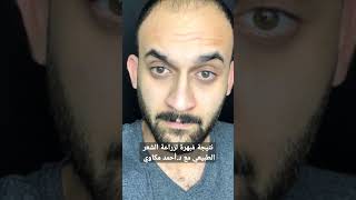 نتيجة مُبهرة لزراعة الشعر الطبيعي مع د.أحمد مكاوي 👌👆