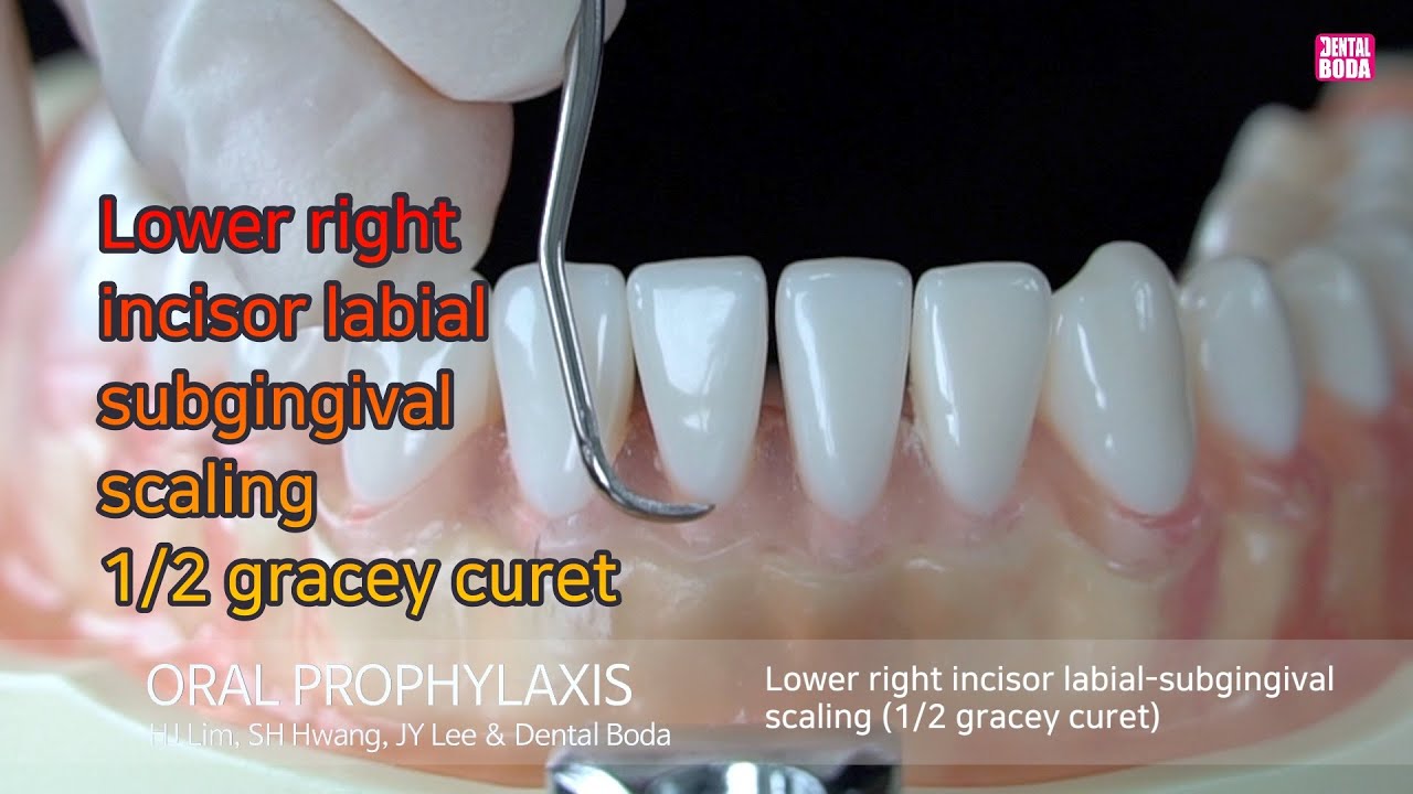 Lower right incisor labial subgingival scaling 1/2 gracey curet