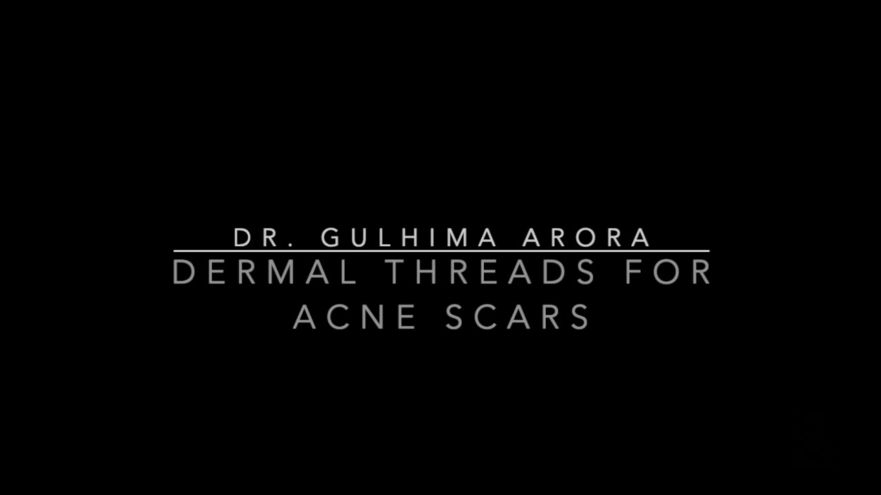 Threads For Scars Dermal threads for acne scars - YouTube