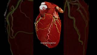 Discover the power of prevention with a CT heart scan at Image One San Diego!