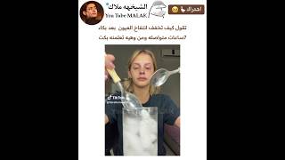 مافي شي يخفي انتفاخ العيون.