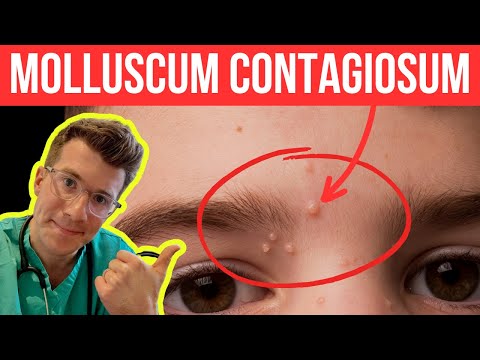 Video: Kas gali užsikrėsti molluscum contagiosum?