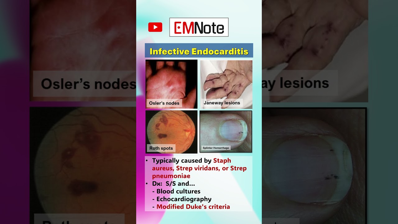 Infective Endocarditis 
