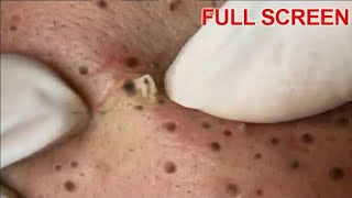 Pimple Popping Satisfying Video : Impressive Blackheads &amp; Cyst Extractions #pimplepopping #acne