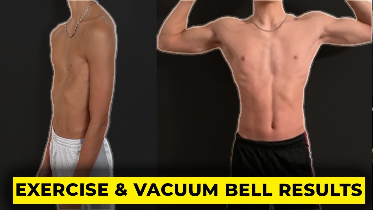 Teenagers Can Fix Their Pectus Excavatum without Surgery! (INSANE