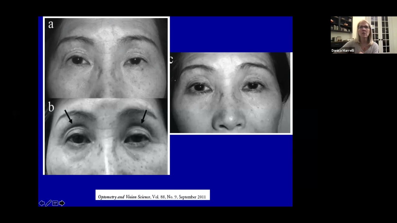 The Glaucoma Grab Bag Practical Guidelines for Effective Glaucoma Management (11/14/2021)