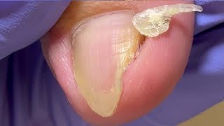 The sharp and long ingrown nails are deeply involuted