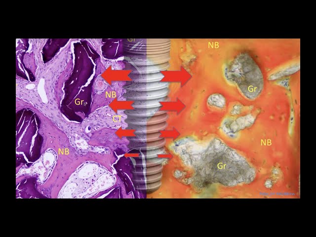 Истинная костная регенерация с EthOss