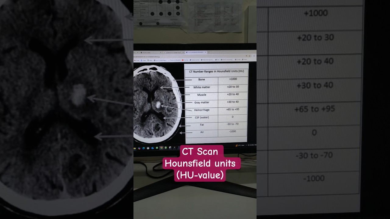 CT Scan Hu (hounsfield units) value #ct#scan#hu#value#hounsfield#units